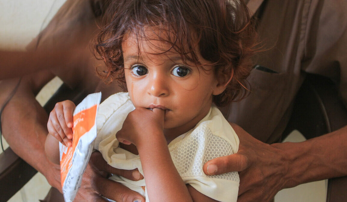 Enfant suivi dans un programme de nutrition au Yémen lié au Programme alimentaire mondial.