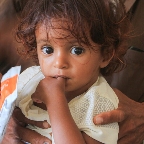 Enfant suivi dans un programme de nutrition au Yémen lié au Programme alimentaire mondial.